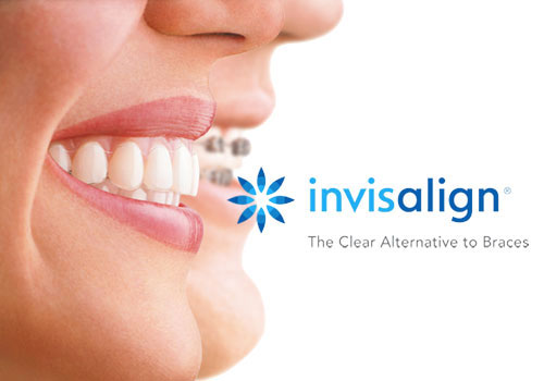 Invisalign Clear Braces BC Orthodontist