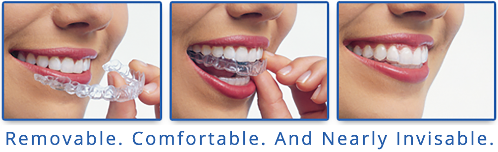 Invisalign Clear Braces, Vancouver Orthodontist