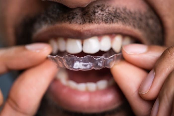 Invisalign Clear Aligners VS Traditional Metal Braces